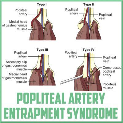 popliteal compression test|popliteal artery entrapment syndrome recovery.